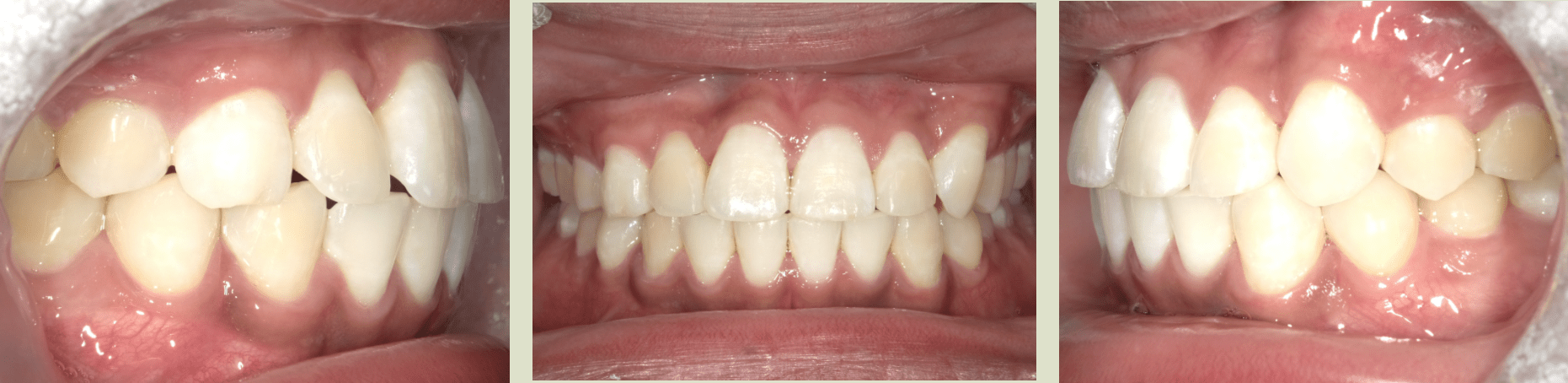 ROW ALM AFTER INVIS TREATMENT